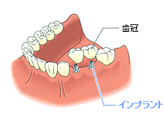 インプラントを埋め込み、その上に人工の歯冠を固定します