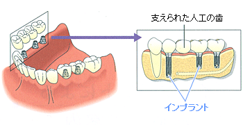 インプラントを埋め込み、その上に人工の歯冠を固定します