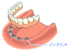 複数のインプラントを埋め込み、人工の歯を固定します