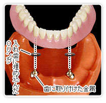 OPアンカーアタッチメント義歯