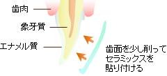 ラミネートベニア
