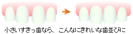 ラミネートベニアの術前・術後