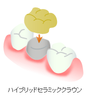 ハイブリッドセラミッククラウン