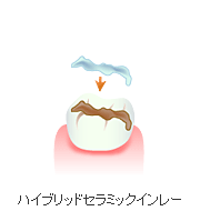 ハイブリッドセラミックインレー