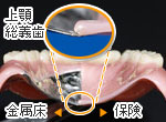金属床義歯