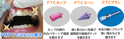 歯科衛生士のPMTCで歯周病予防