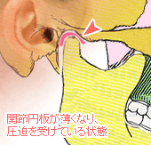 関節円板が薄くなり、圧迫を受けている状態