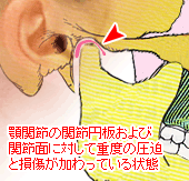 顎関節の関節円板および関節面に対して重度の圧迫と損傷が加わっている状態