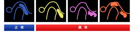 顎関節円板の転移と変形