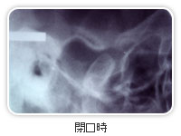 開口時
