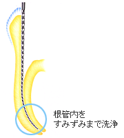 根管内をすみずみまで洗浄