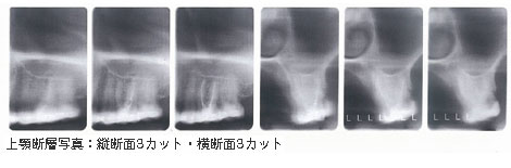 上顎断層写真
