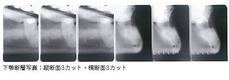 下顎断層写真