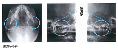 顎関節写真